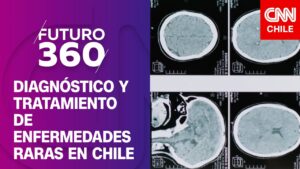 La lucha por el diagnóstico y tratamiento de las enfermedades raras en Chile | Futuro 360